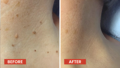 Derma Smooth Skin Tag Removal Patch | Secret to Spotless Skin ✨